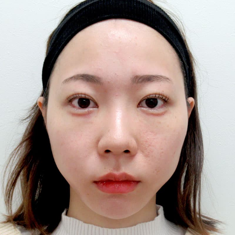 20260315_G23705_furumura_nose-prosthesis②Before