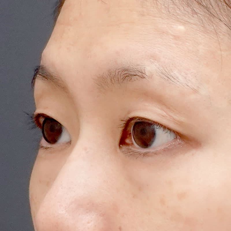 20260315_N111709_osada_hyaluronic acid above the eyes①After