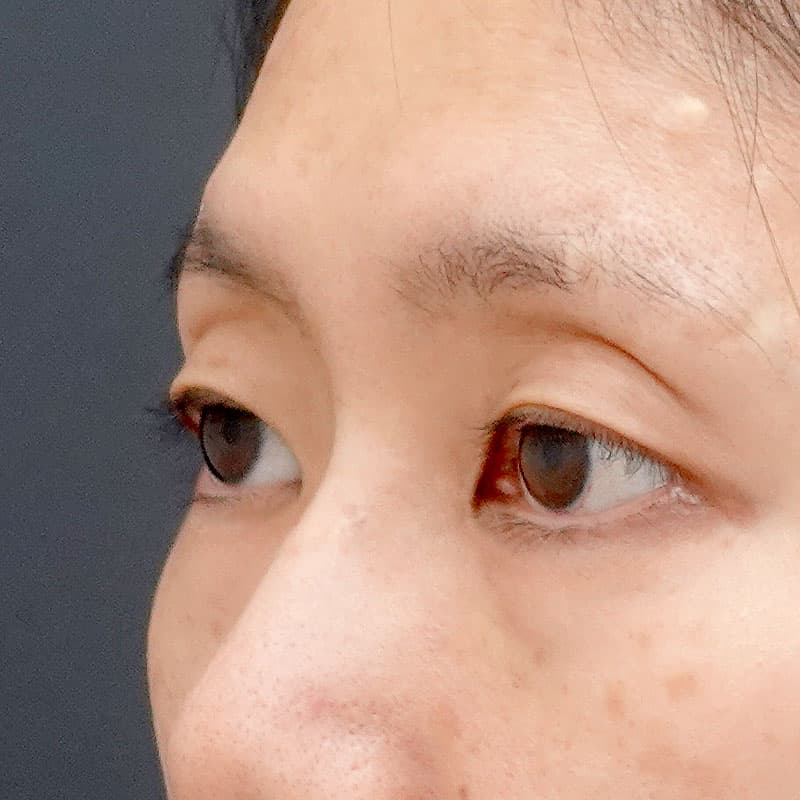 20260315_N111709_osada_hyaluronic acid above the eyes①Before