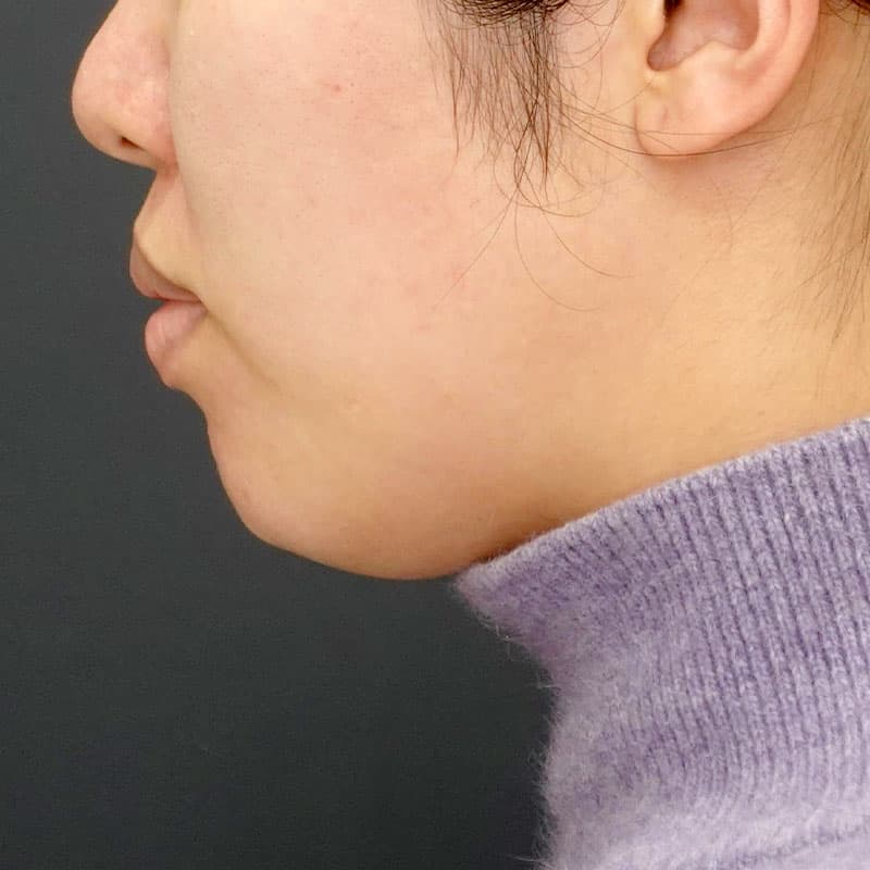 20260315_N114165_volnewmer①Before