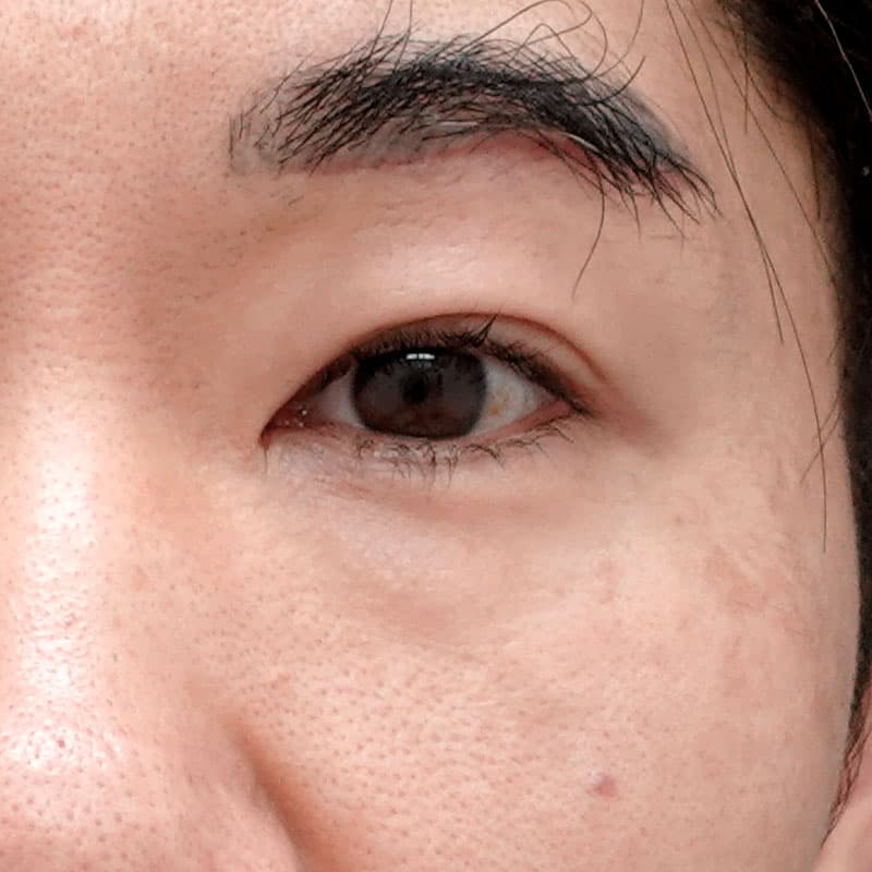 20260315_N138034_takemura_back-hamura-method①Before