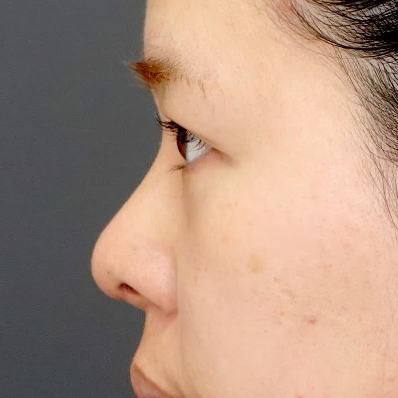 20260315_N23012_kaneko_nose tip reduction-auricular cartilage①After
