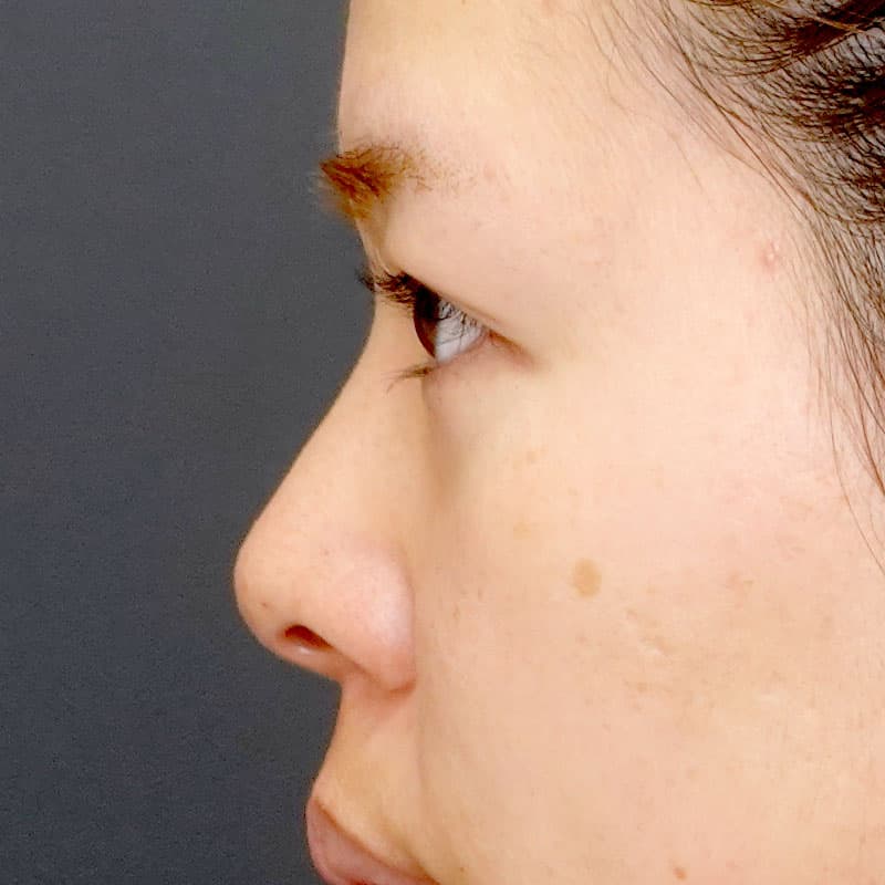 20260315_N23012_kaneko_nose tip reduction-auricular cartilage①Before