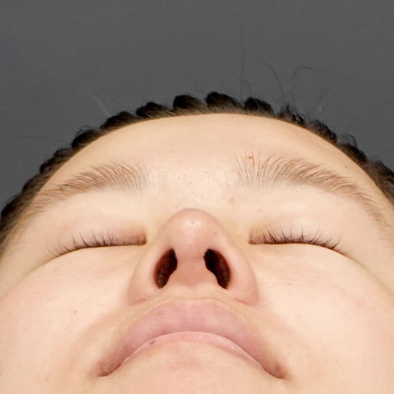 20260315_N23012_kaneko_nose tip reduction-auricular cartilage②After