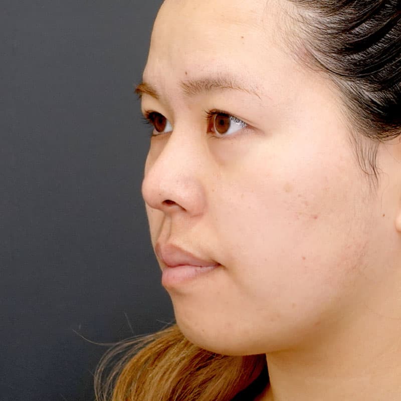 20260315_N23012_kaneko_nose tip reduction-auricular cartilage③After