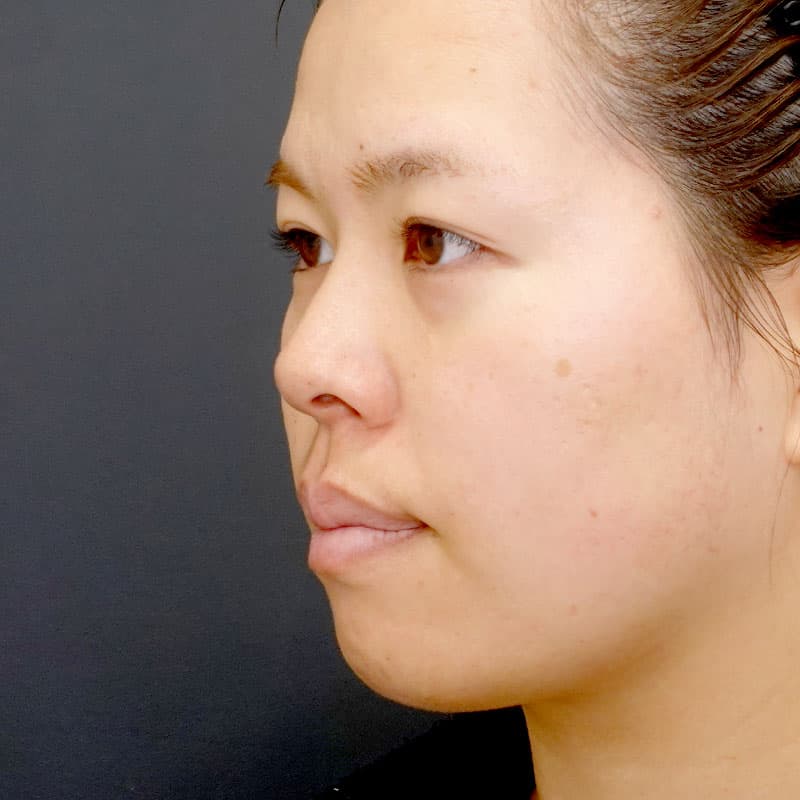 20260315_N23012_kaneko_nose tip reduction-auricular cartilage③Before