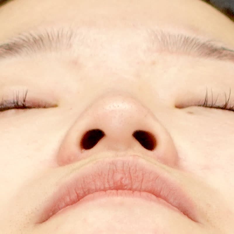 20260315_N27967_furumura_nostril reduction①After