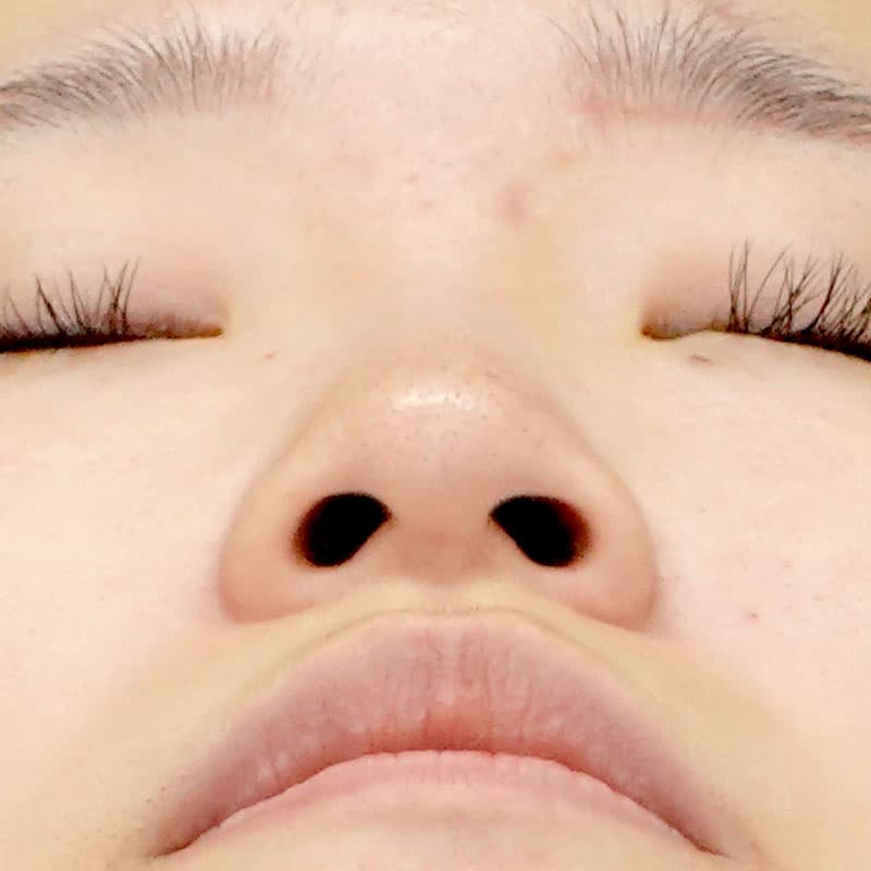 20260315_N27967_furumura_nostril reduction①Before