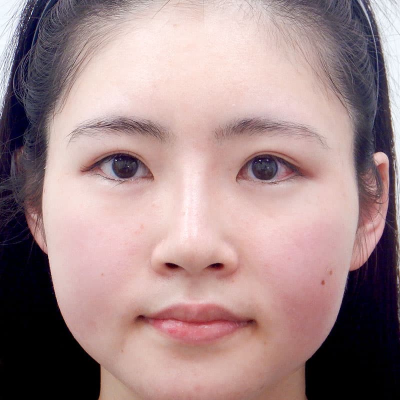 20260315_N30495_takemura_nose-prosthesis①After