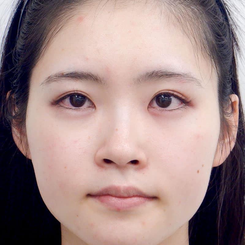 20260315_N30495_takemura_nose-prosthesis①Before