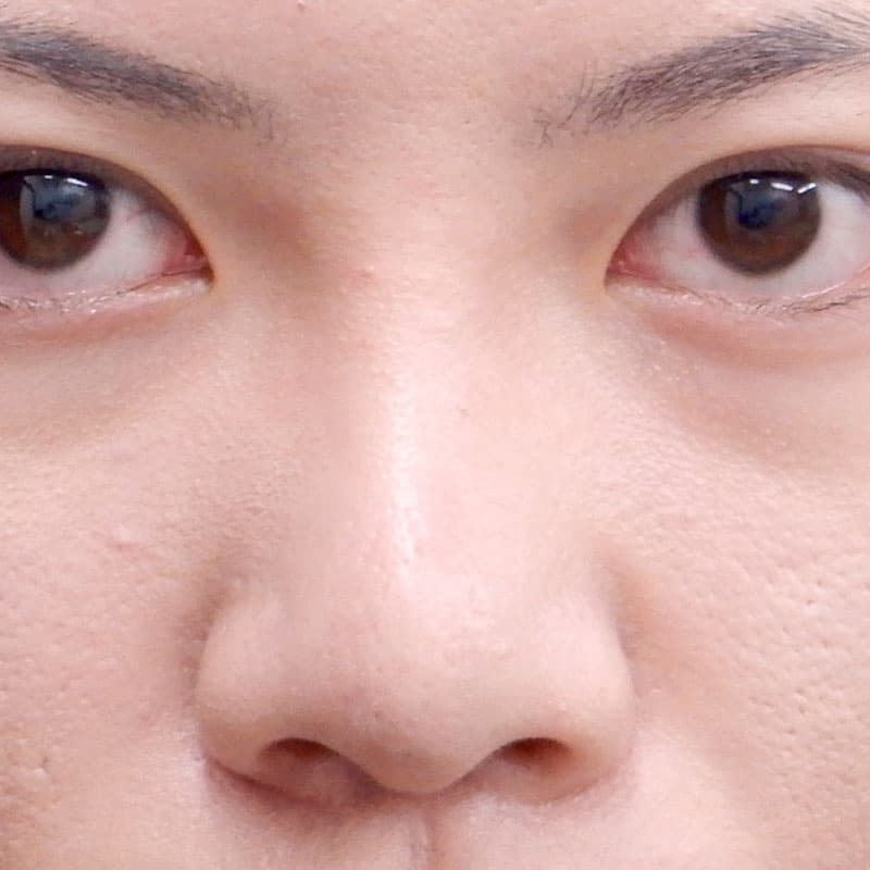 20260315_N36487_takemura_nose-prosthesis①After