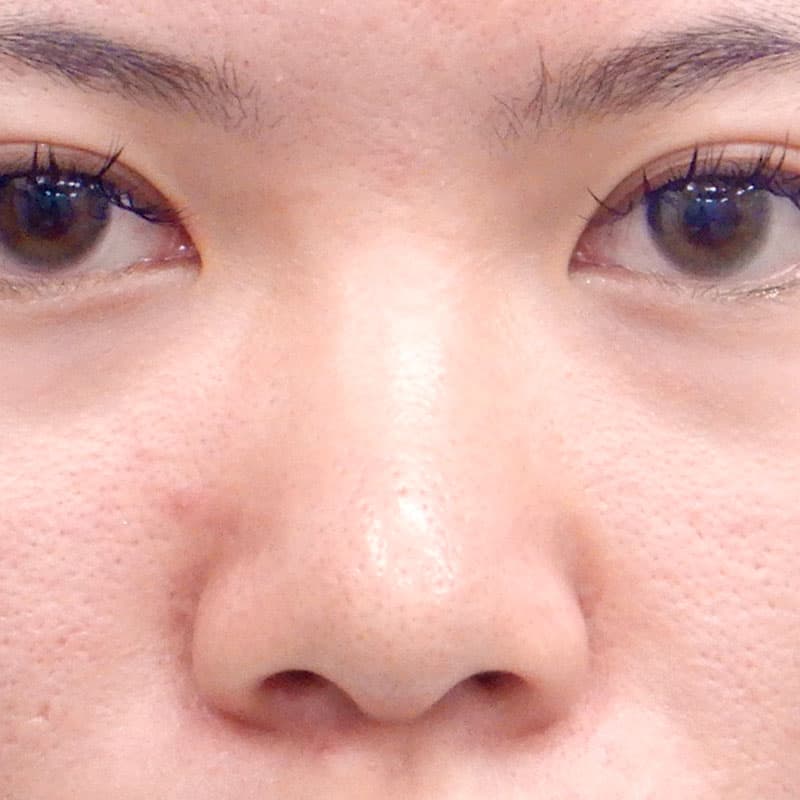 20260315_N36487_takemura_nose-prosthesis①Before