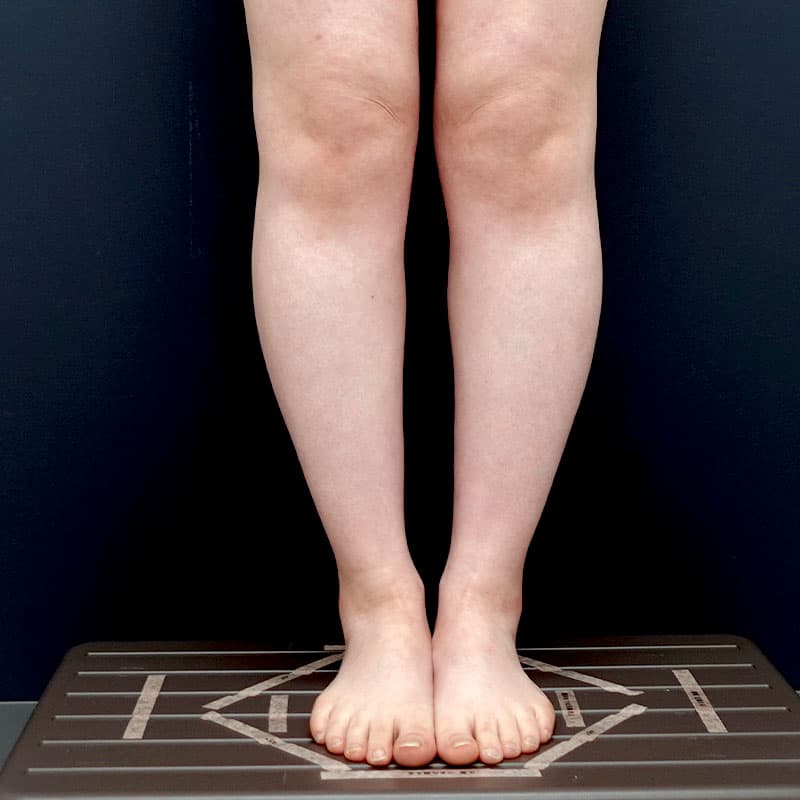 20260315_N37169_takemura_calf-liposuction①After