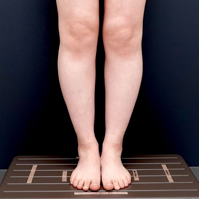 20260315_N37169_takemura_calf-liposuction①Before