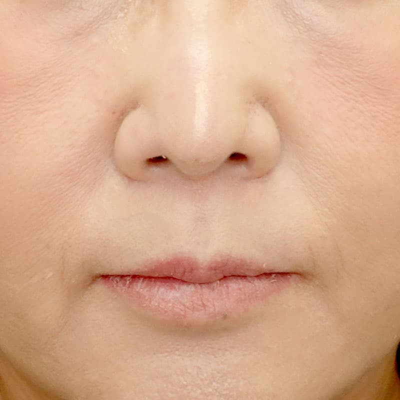 20260315_N48891_kaneko_nose tip reduction-auricular cartilage①After