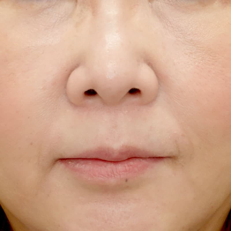 20260315_N48891_kaneko_nose tip reduction-auricular cartilage①Before