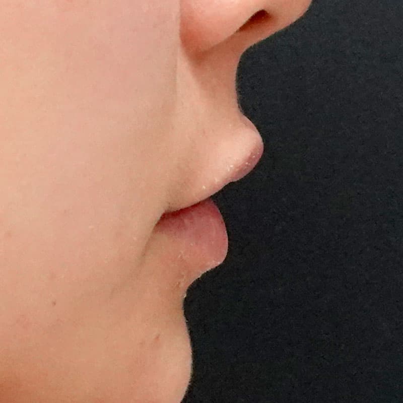 20260322_St20260322-2_hosono_hyaluronic lips①After