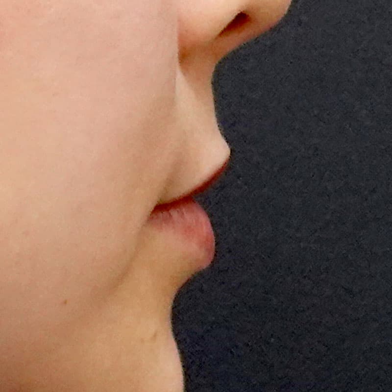 20260322_St20260322-2_hosono_hyaluronic lips①Before