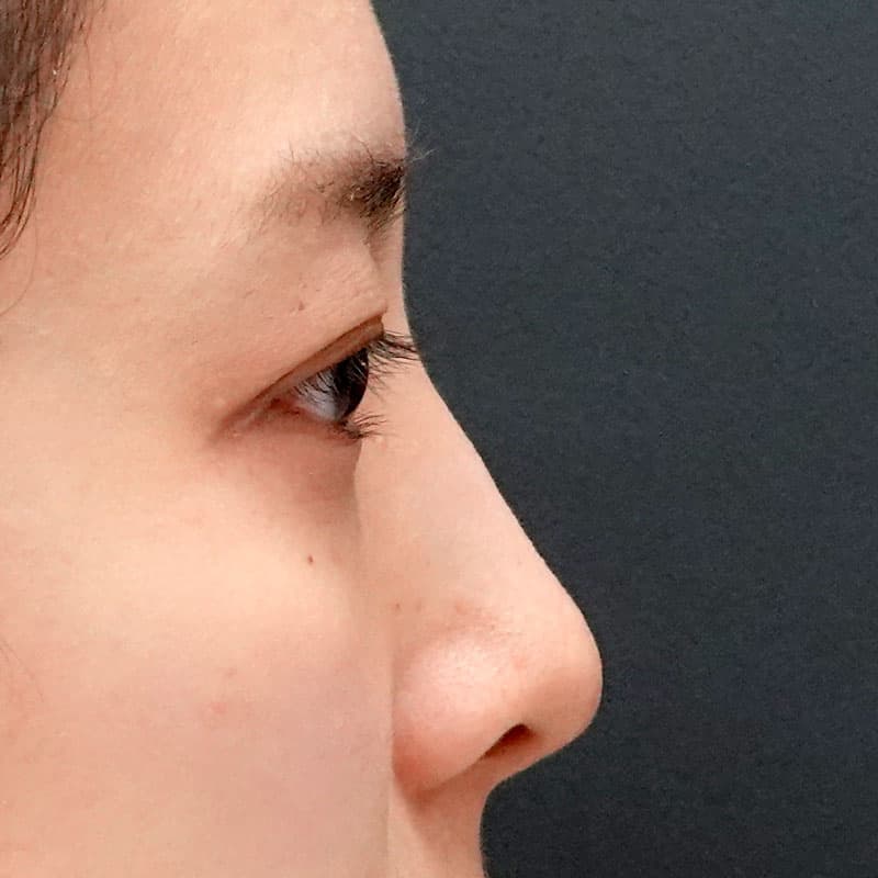 20260322_St20260322-3_hosono_hyaluronic nose①After