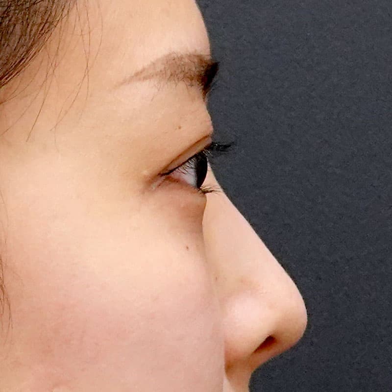 20260322_St20260322-3_hosono_hyaluronic nose①Before