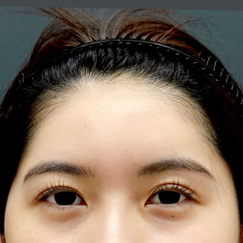 20260322_St20260322-4_takee_hyaluronic forehead-hyaluronic temples②After