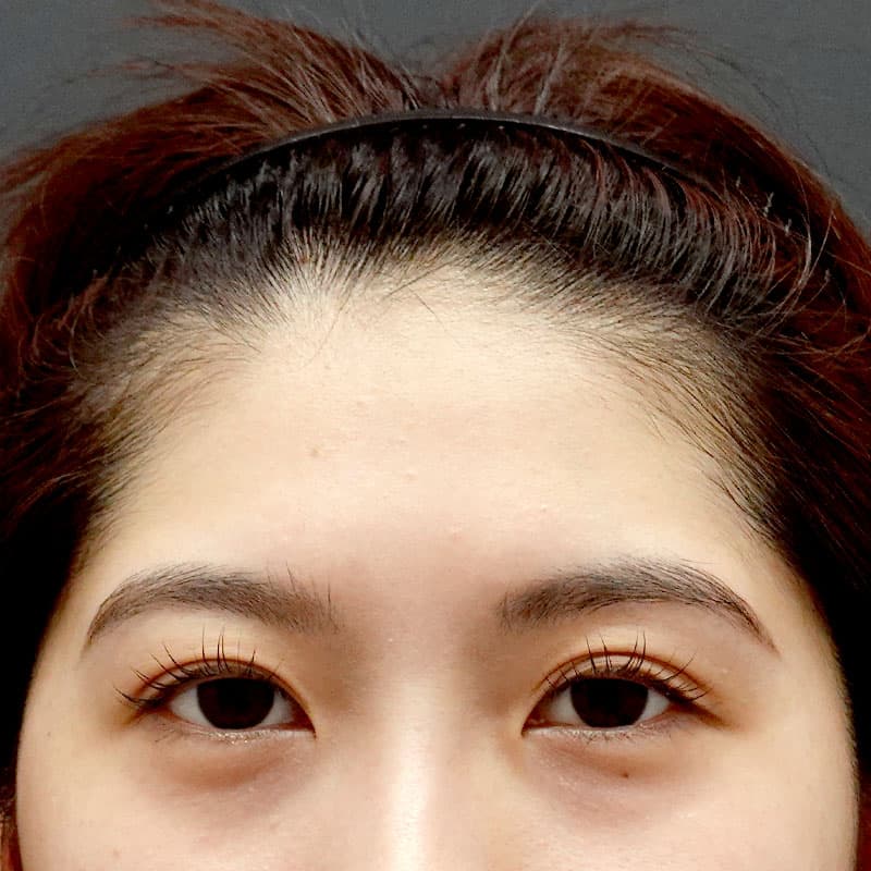 20260322_St20260322-4_takee_hyaluronic forehead-hyaluronic temples②Before