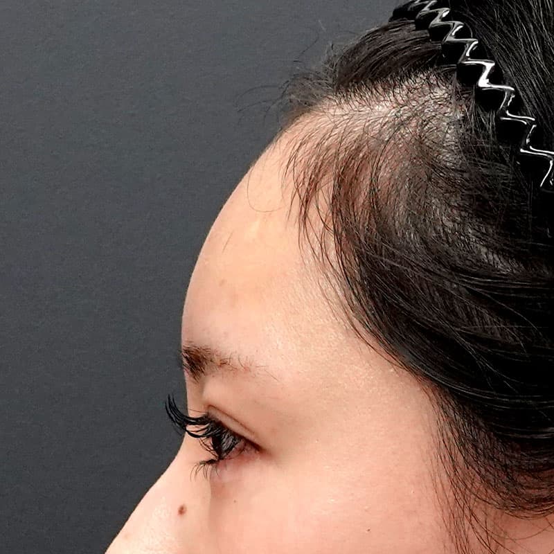 20260322_St20260322-5_sohono_hyaluronic forehead①After