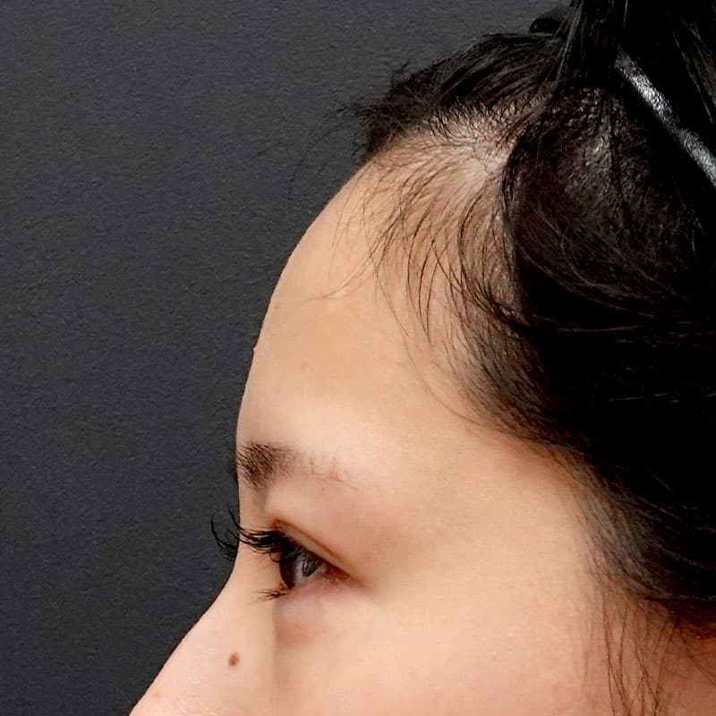 20260322_St20260322-5_sohono_hyaluronic forehead①Before