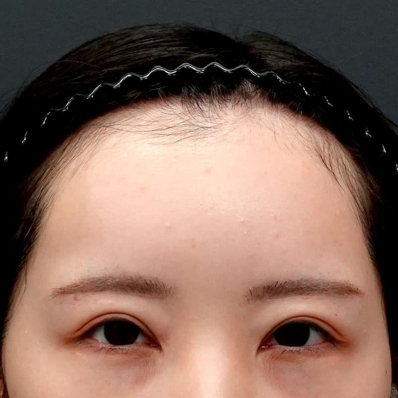 20260322_St20260322-6_hosono_hyaluronic forehead-hyaluronic temples①After