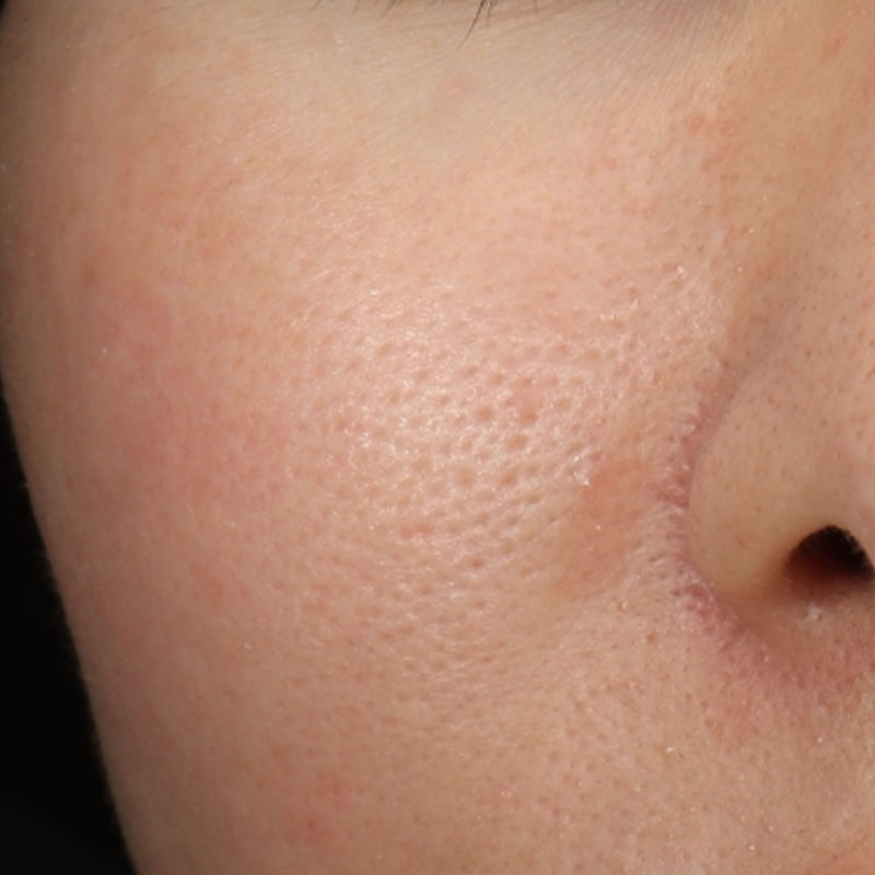 20240504_S20240504_Dr.mayuko_micro botox 横②After