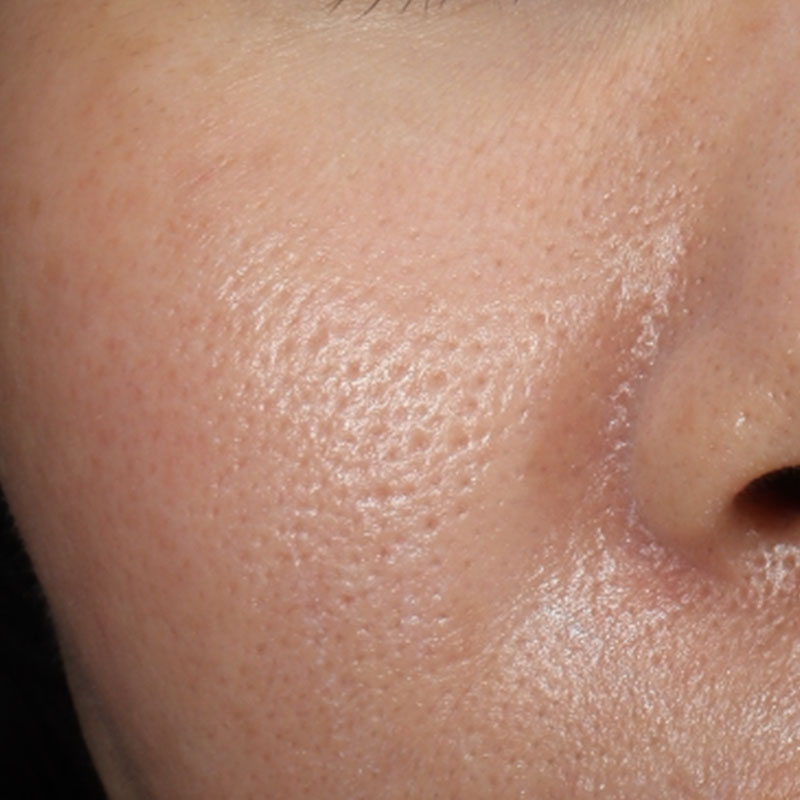 20240504_S20240504_Dr.mayuko_micro botox 横②Before