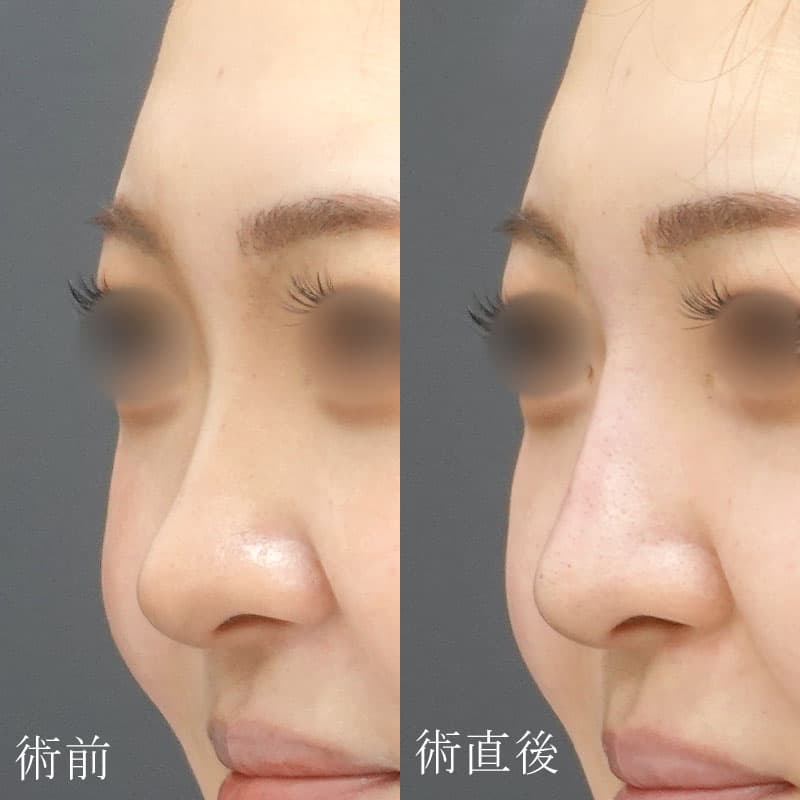 鼻のヒアルロン酸の症例写真