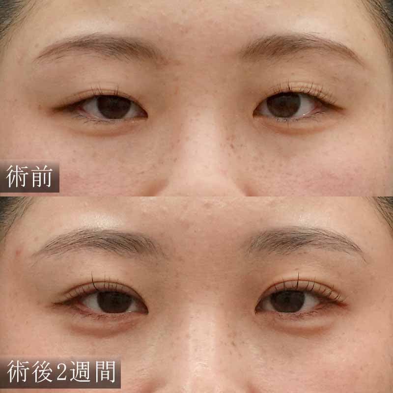二重埋没法と涙袋ヒアルロン酸の症例写真【細野医師】