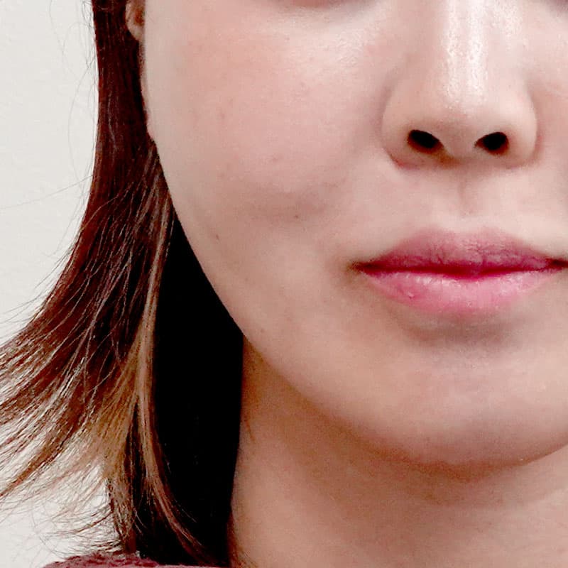 20260403_St20260403-2_koito_hyaluronic acid in the cheeks①Before