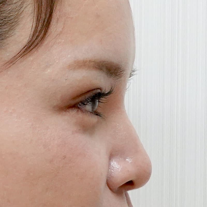 20260406_St20260406-1_sugishima_hyaluronic nose①After