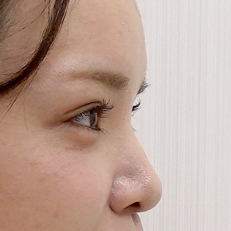 20260406_St20260406-1_sugishima_hyaluronic nose①Before