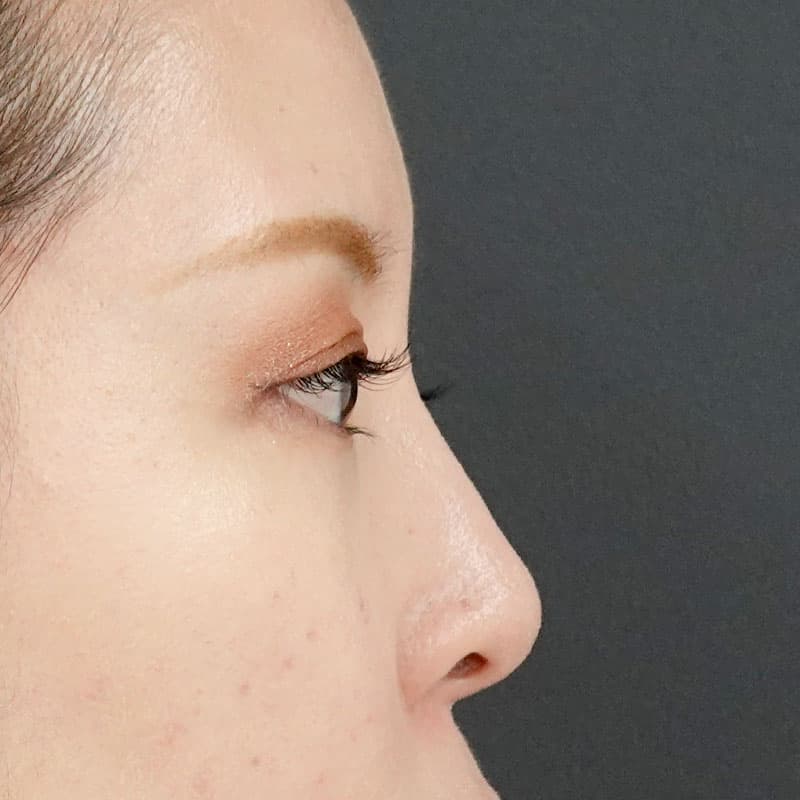 20260406_St20260406-2_ota_hyaluronic nose①After