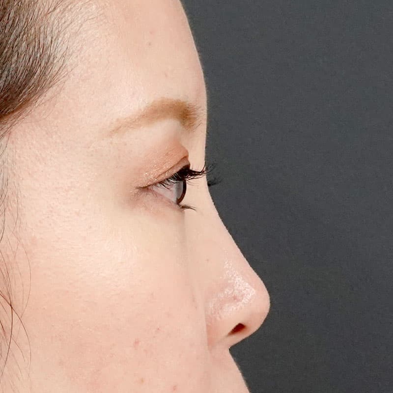 20260406_St20260406-2_ota_hyaluronic nose①Before