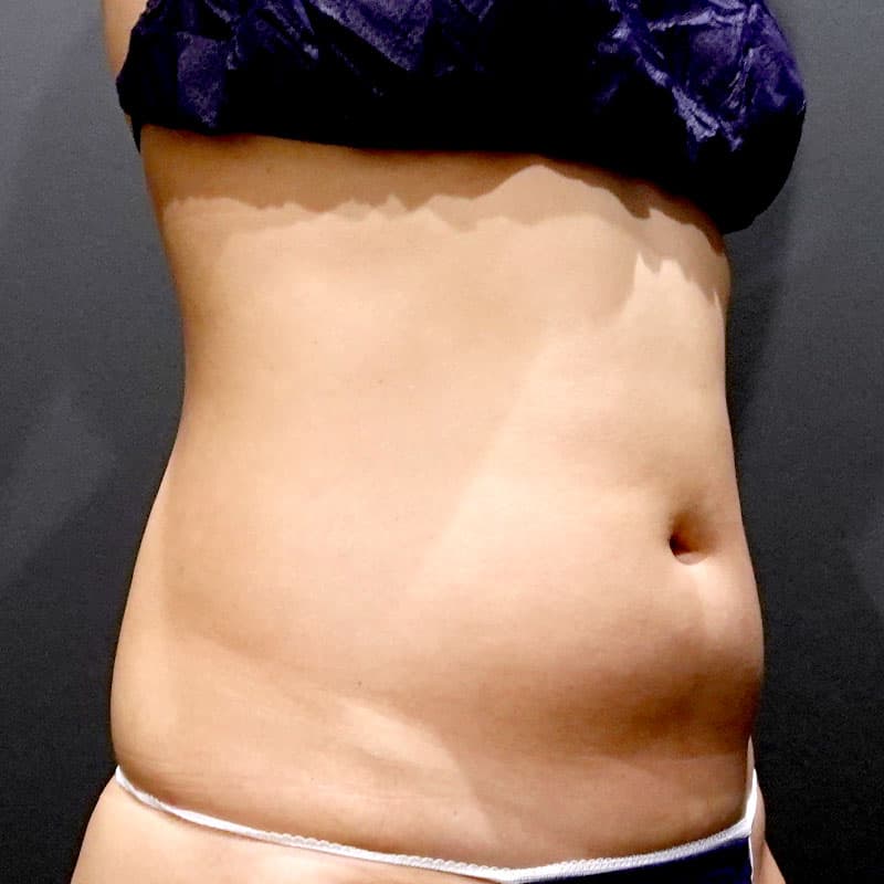 20260408_G40495_osada_stomach-liposuction②Before