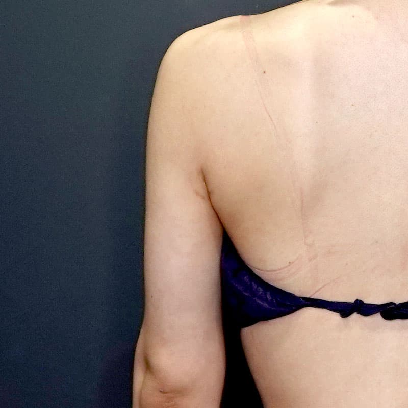 20260408_St20260408-1_osada_arm-liposuction①After