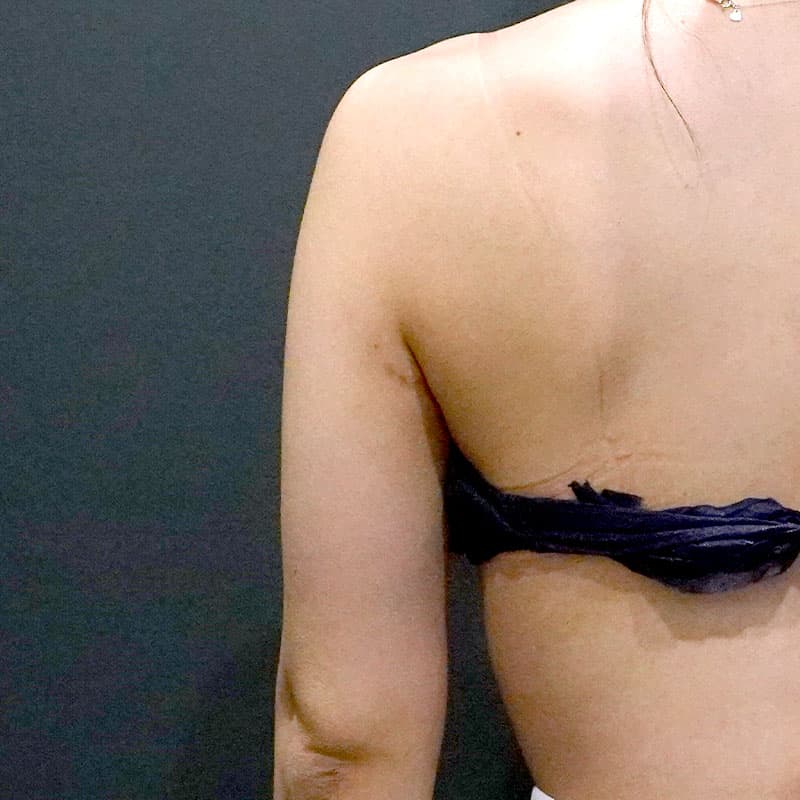 20260408_St20260408-1_osada_arm-liposuction①Before