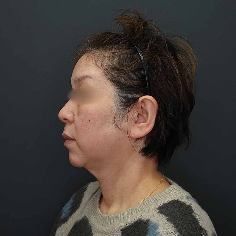 20260413_H166235_volformer①After