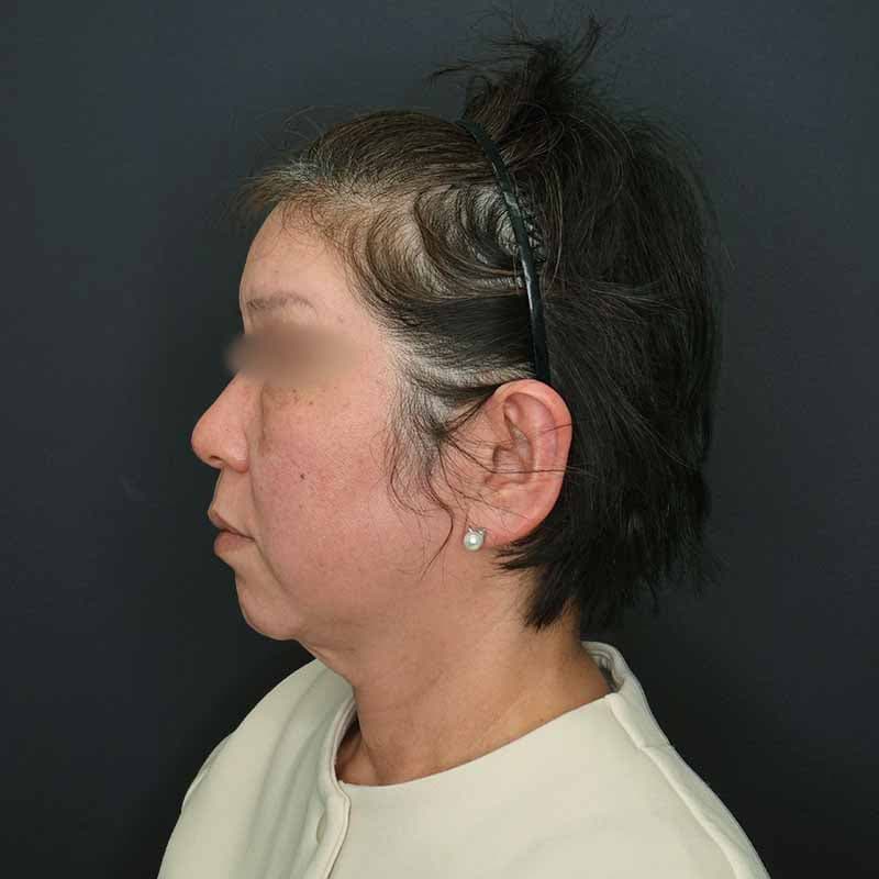 20260413_H166235_volformer①Before