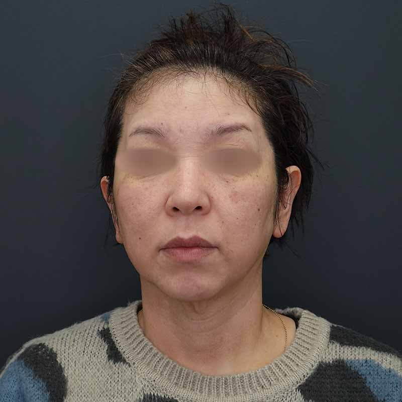 20260413_H166235_volformer②After