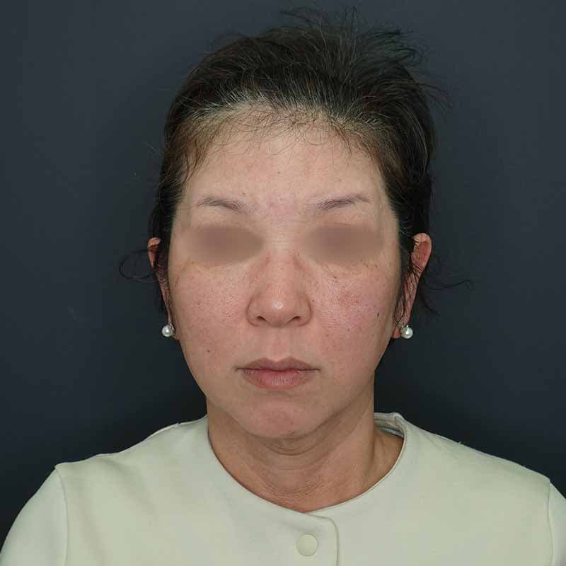 20260413_H166235_volformer②Before