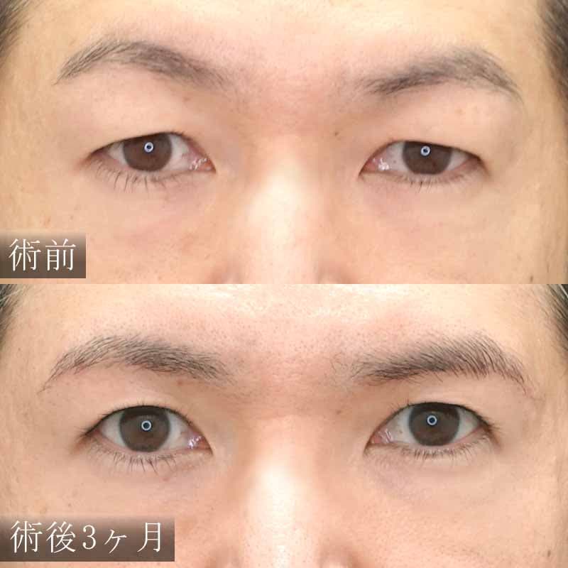 眉下切開法 症例