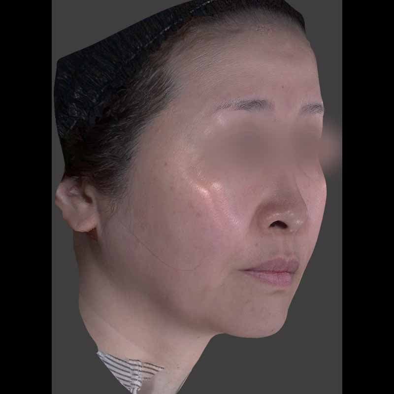 20260415_H164039_volformer①Before