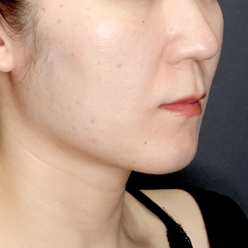 20260417_G28304_morishima_face-liposuction_philtrum-botox①After