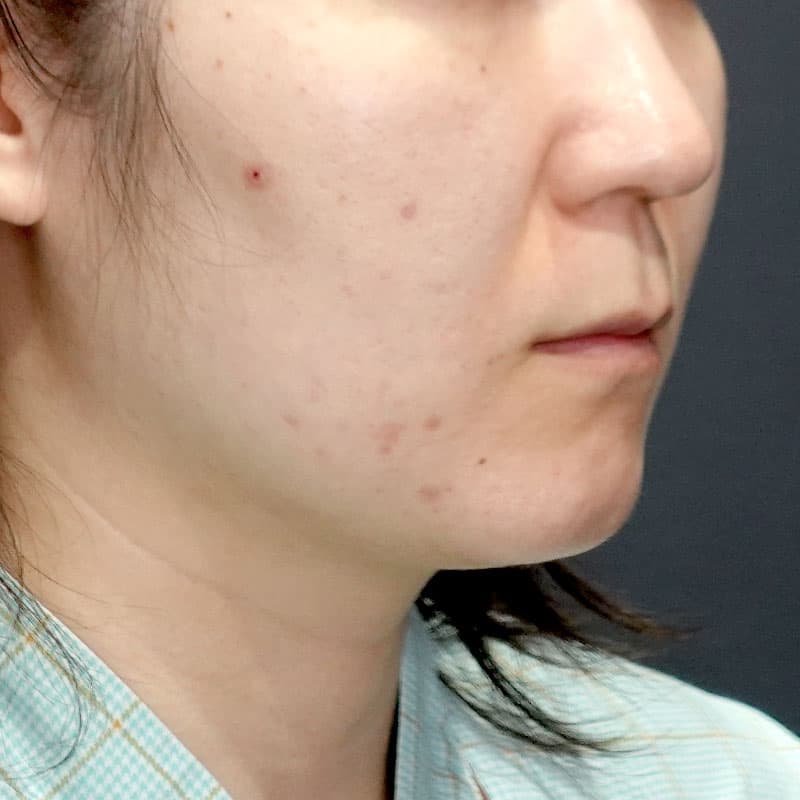 20260417_G28304_morishima_face-liposuction_philtrum-botox①Before