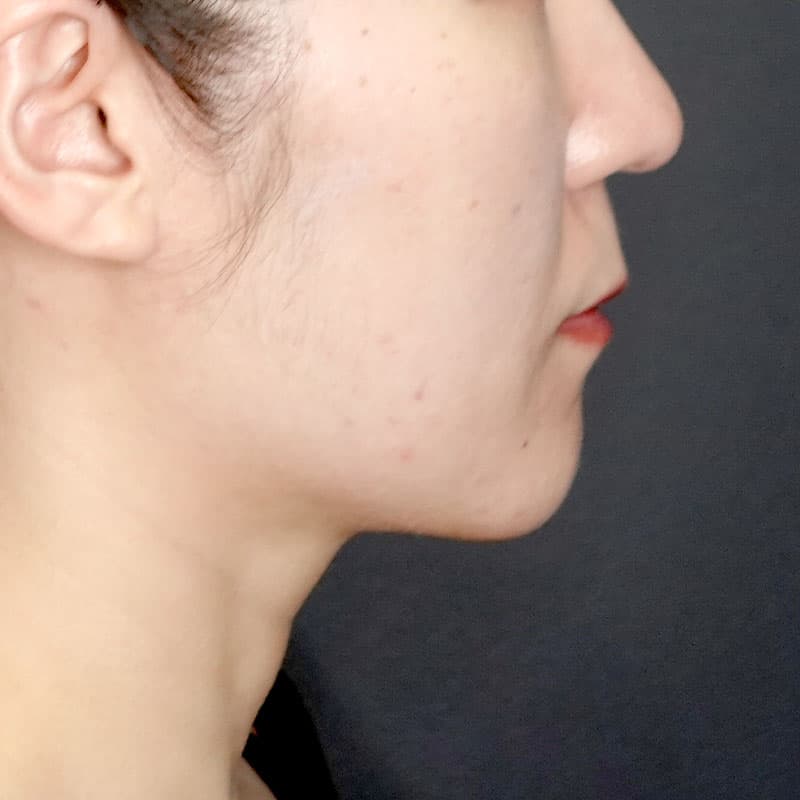 20260417_G28304_morishima_face-liposuction_philtrum-botox②After